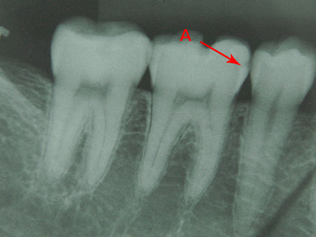A  初期のむし歯