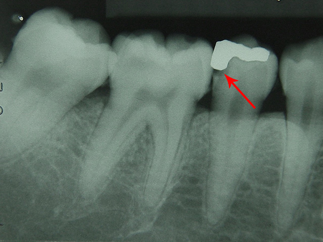 症例 1　歯がしみる　写真1
