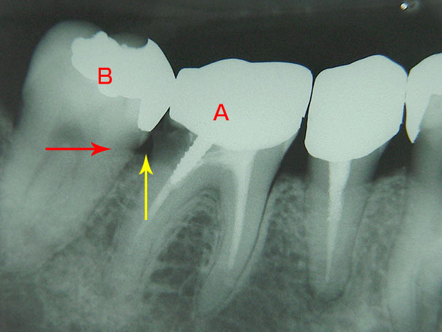 症例 3　歯肉に違和感があります　写真1