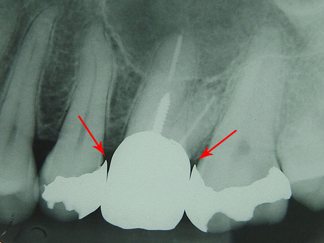 症例 5　歯間ブラシが引っかかってうまく通りません　写真1