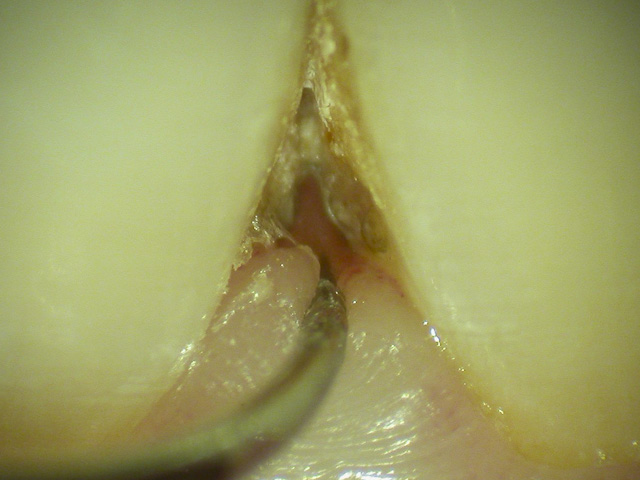 歯肉縁上歯石　写真2