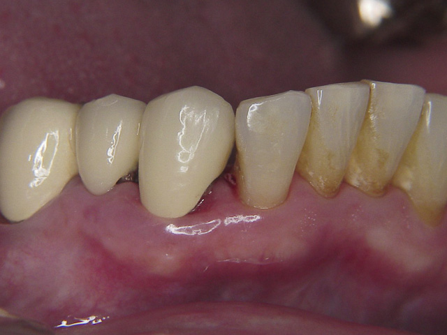 症例 1／59歳 女性　歯石除去後写真